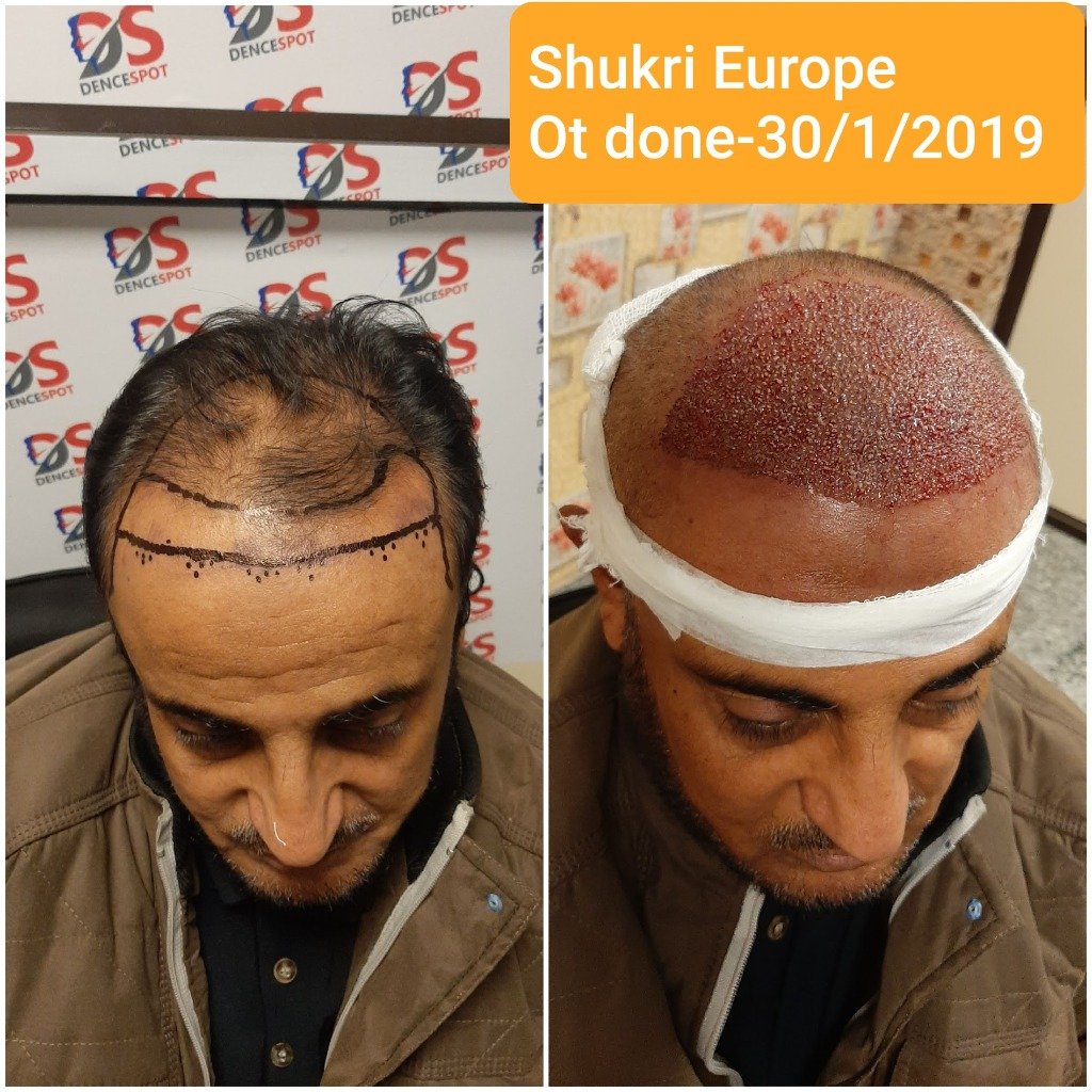 Shukri — High-Density Frontal Grafts