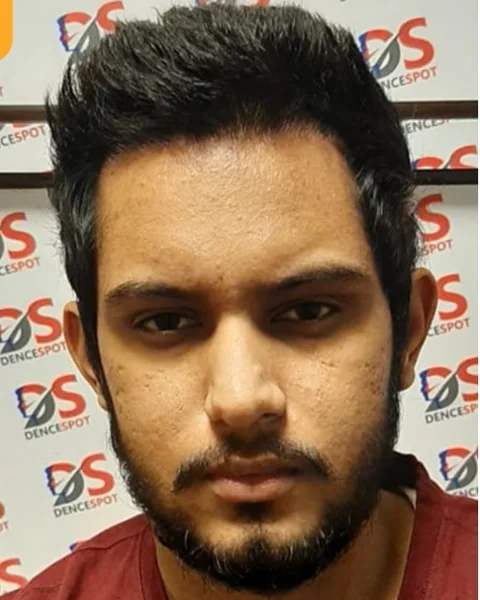 After: the same patient 12 months after a 2,400 grafts FUE hair transplant