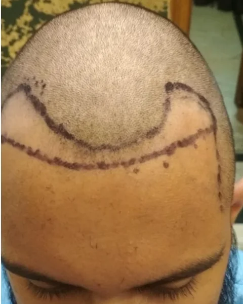 Before: a DenceSpot patient’s scalp with the planned hairline drawn before an FUE hair transplant