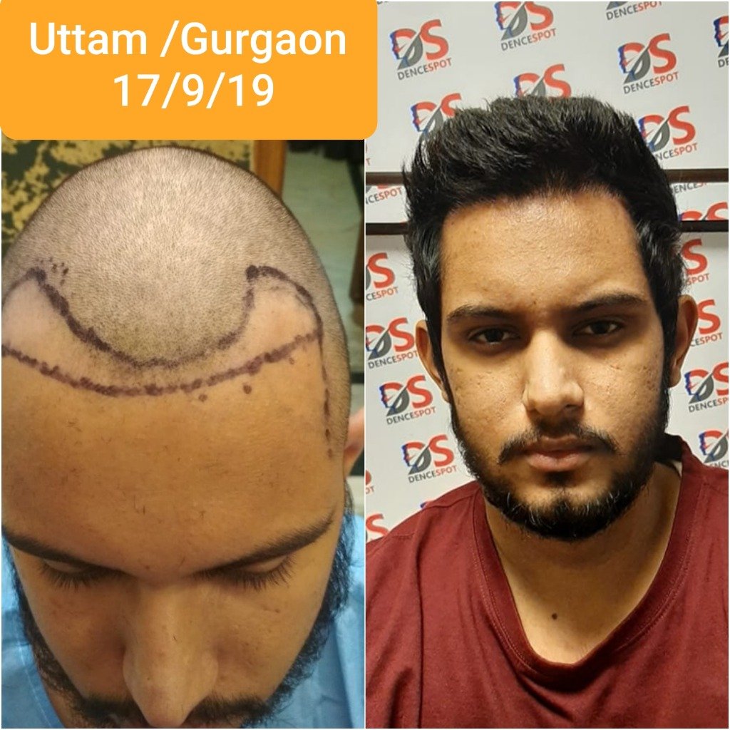 Uttam — Hairline & Temple Restoration