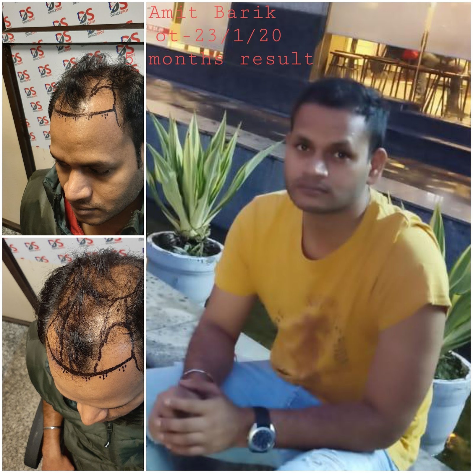 DenceSpot Patient Result Transformation