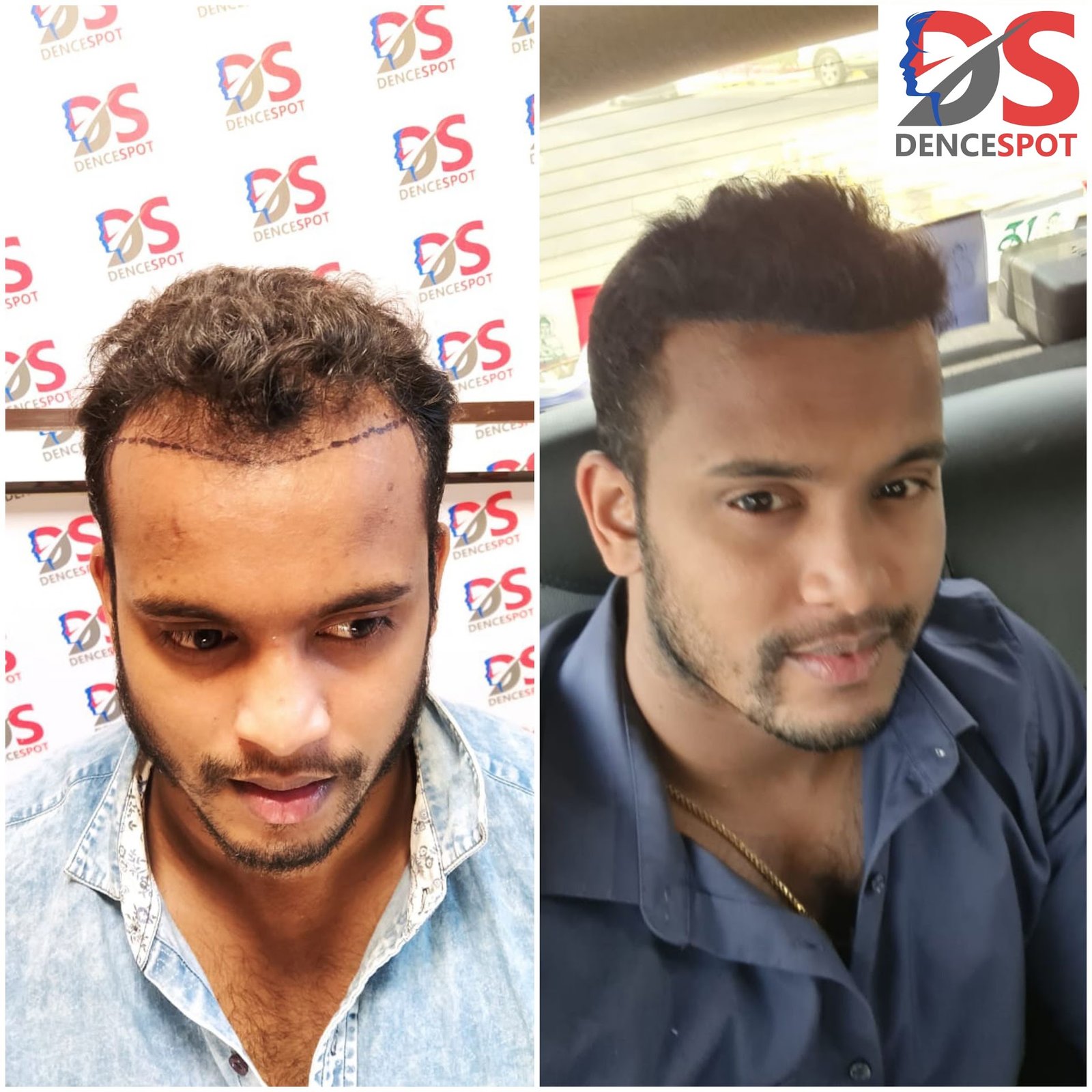 DenceSpot Patient Result Transformation