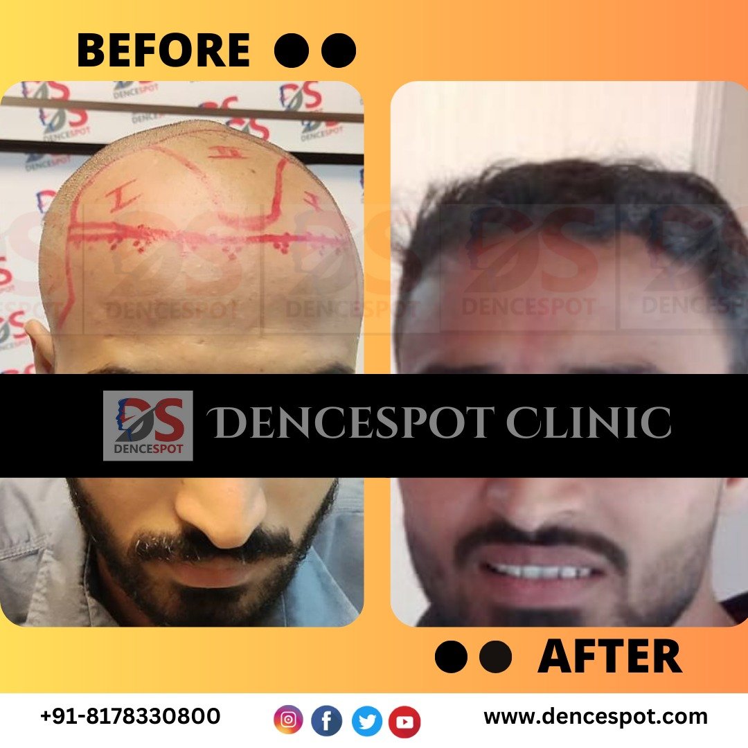 DenceSpot Patient Result Transformation