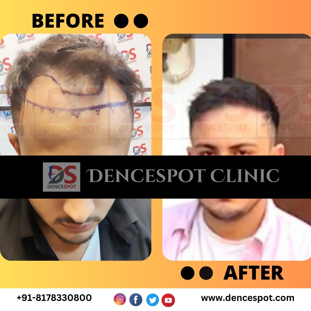 Before and after a hair transplant at DenceSpot Clinic, Sector 39 Gurugram — case 9