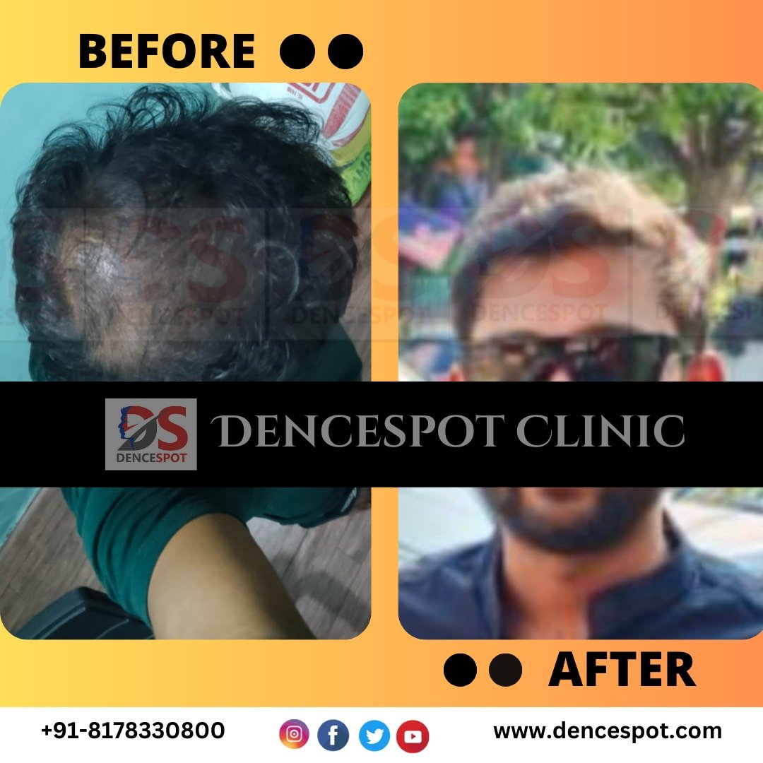 Before and after a hair transplant at DenceSpot Clinic, Sector 39 Gurugram — case 10