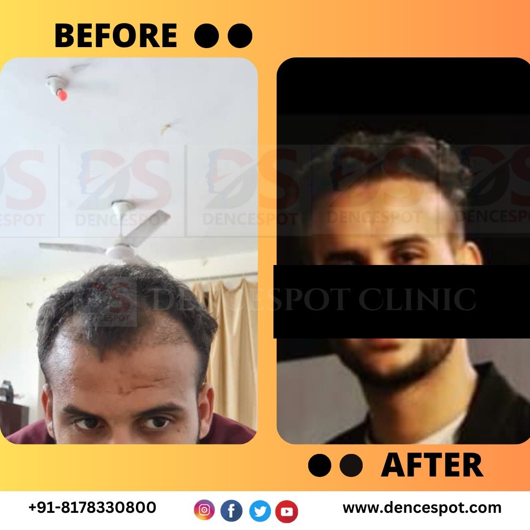 Before and after a hair transplant at DenceSpot Clinic, Sector 39 Gurugram — case 11