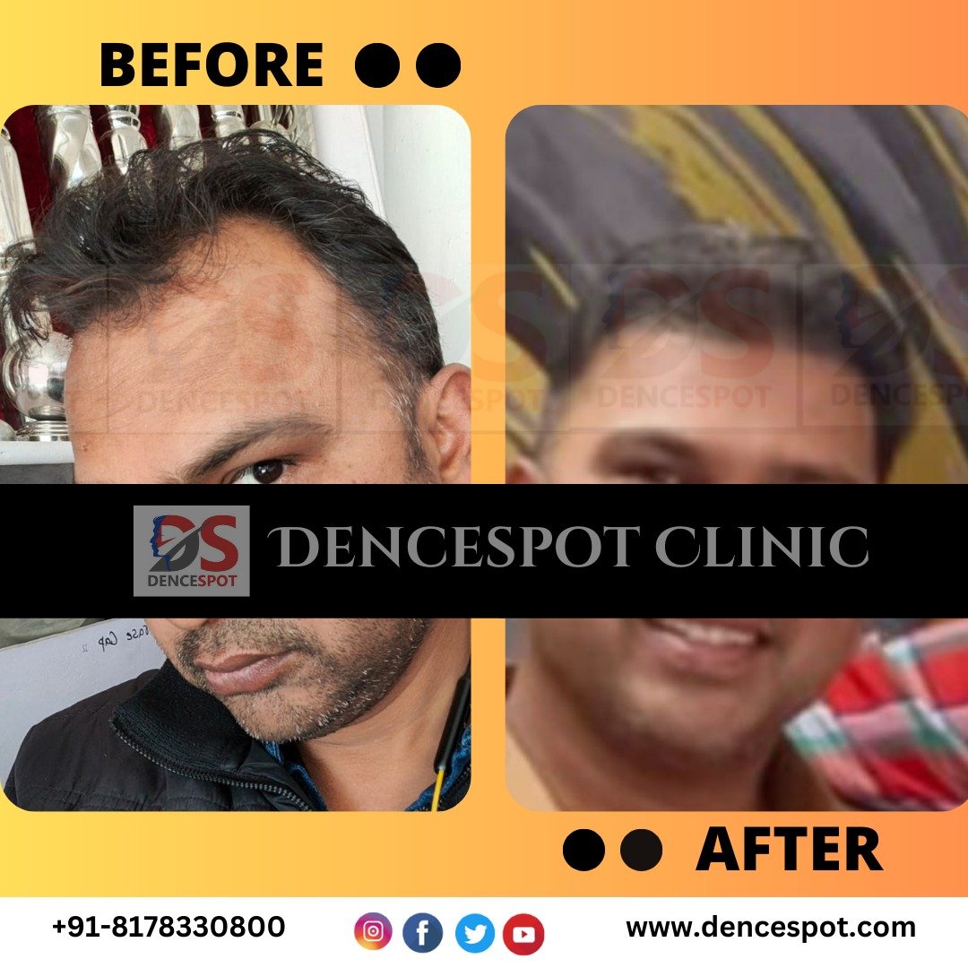 Before and after a hair transplant at DenceSpot Clinic, Sector 39 Gurugram — case 12
