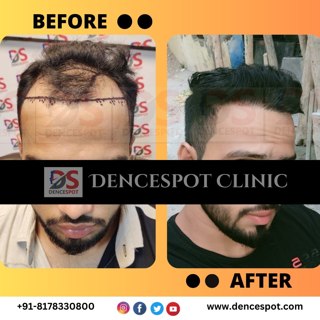 Before and after a hair transplant at DenceSpot Clinic, Sector 39 Gurugram — case 13