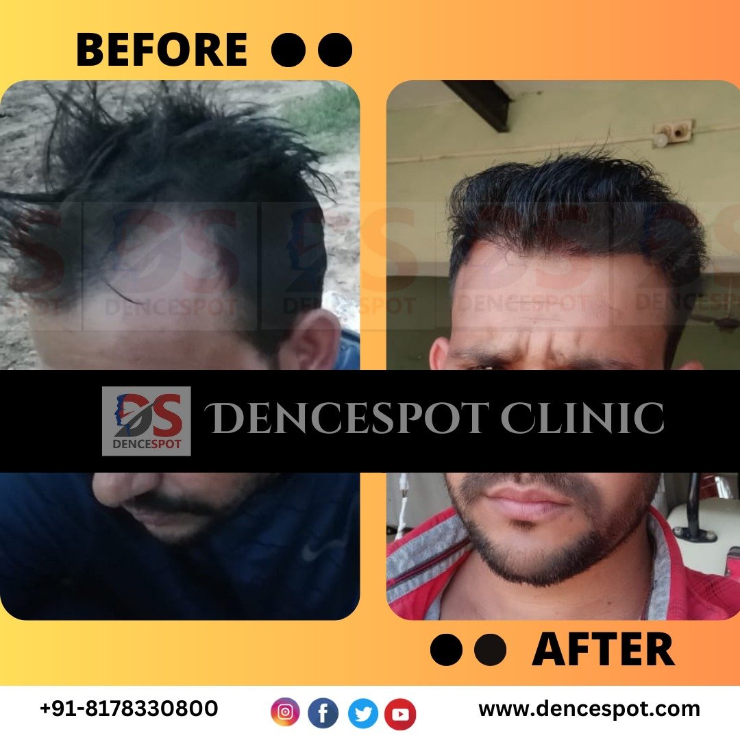 Before and after a hair transplant at DenceSpot Clinic, Sector 39 Gurugram — case 14