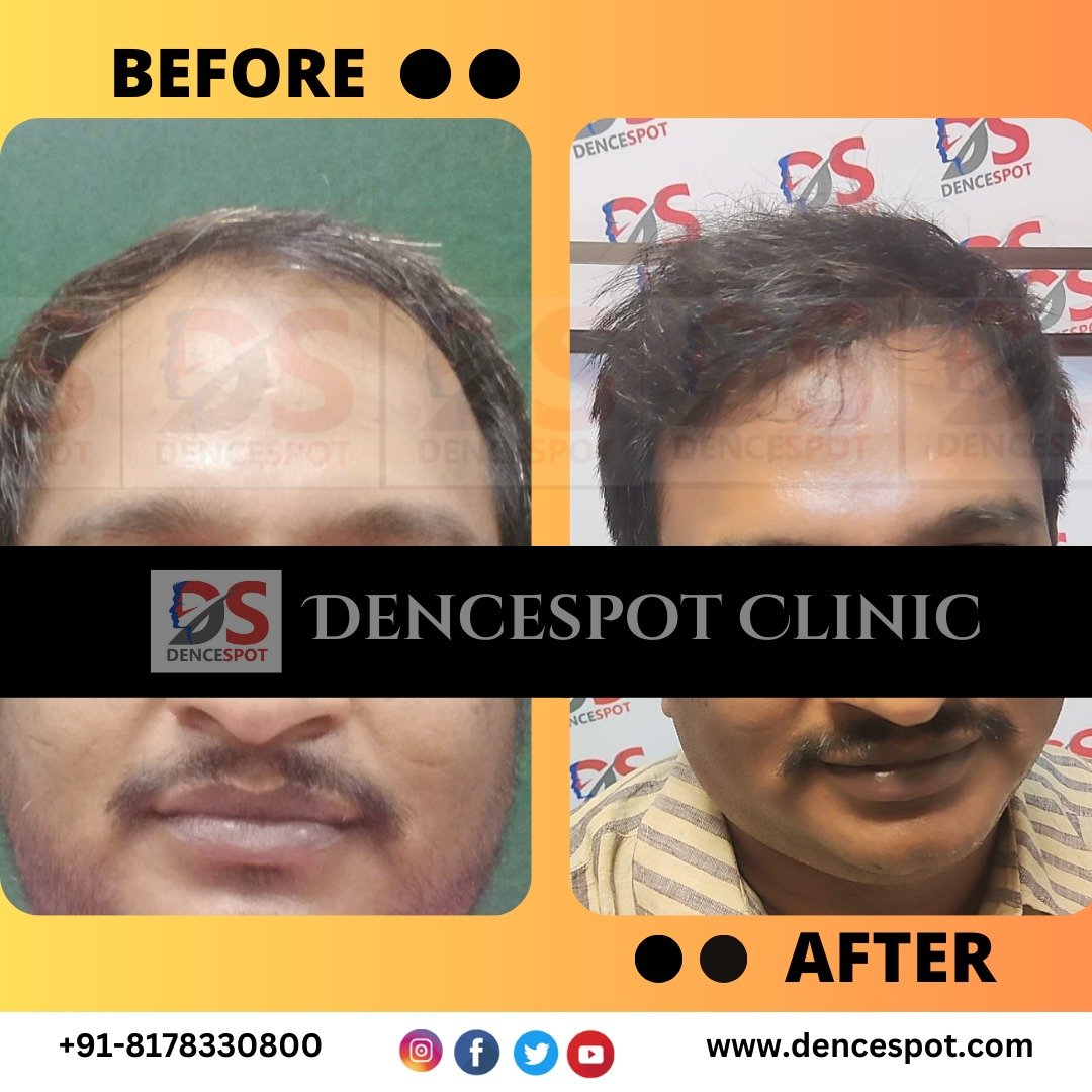Before and after a hair transplant at DenceSpot Clinic, Sector 39 Gurugram — case 15