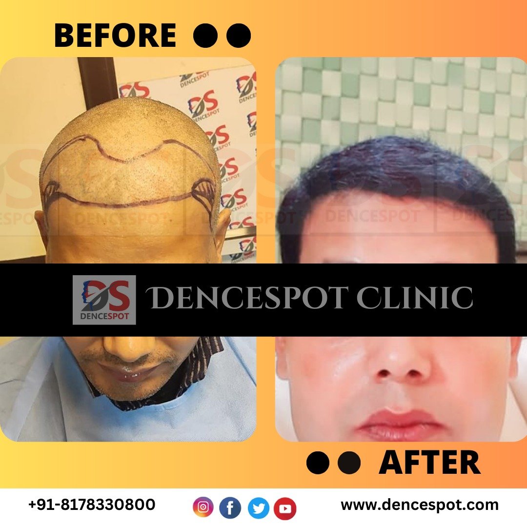 Before and after a hair transplant at DenceSpot Clinic, Sector 39 Gurugram — case 16