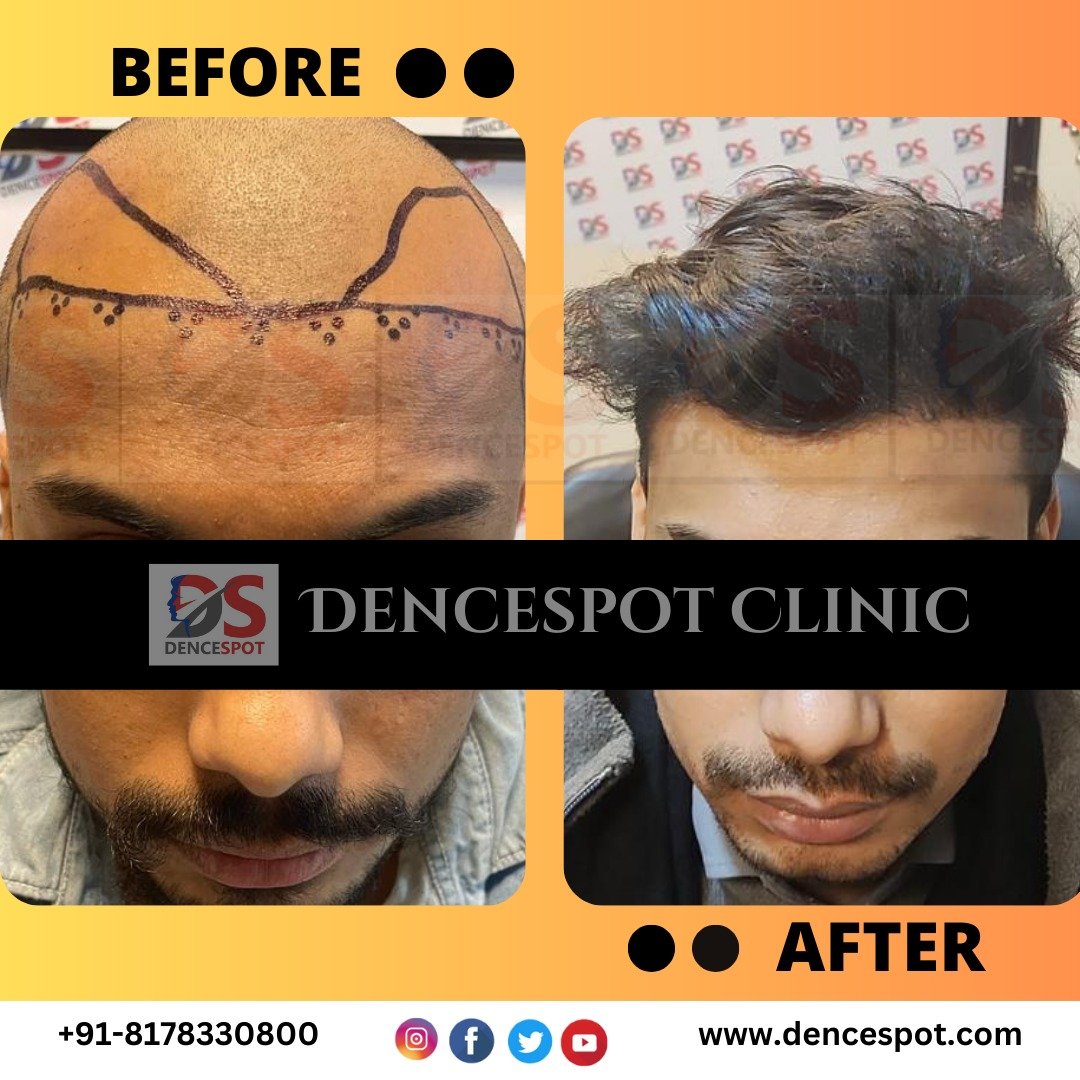 DenceSpot Patient Result Transformation
