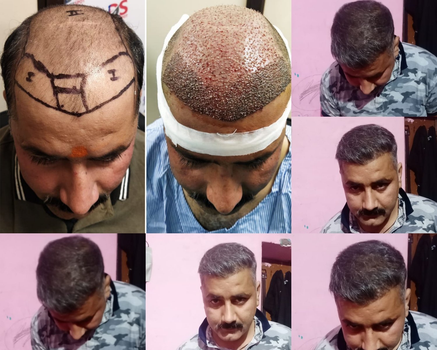 DenceSpot Patient Result Transformation
