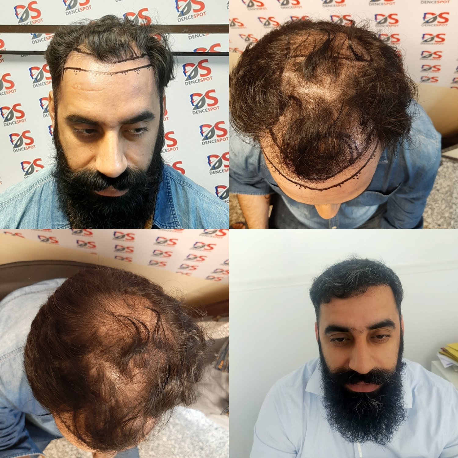 DenceSpot Patient Result Transformation