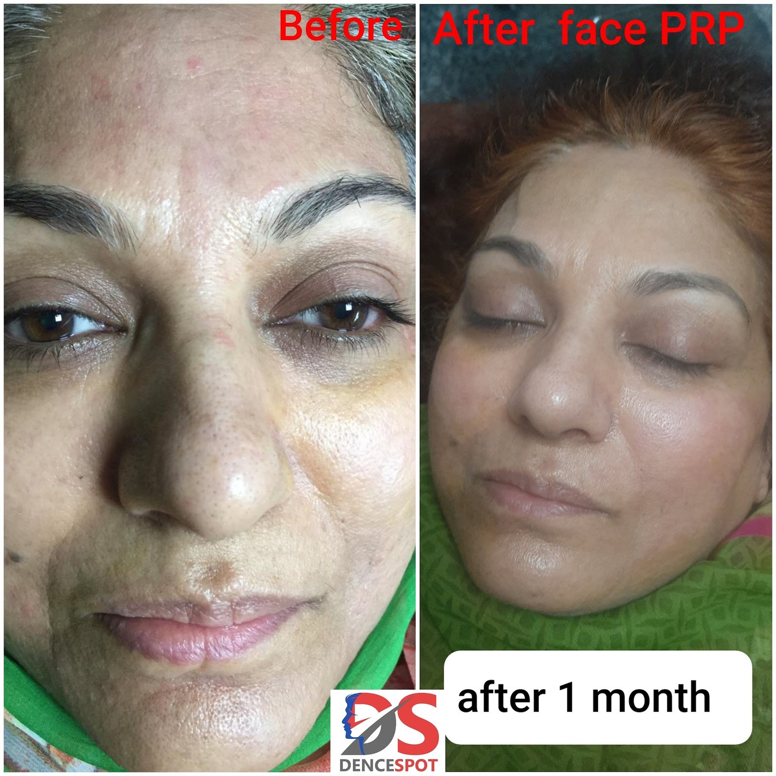 DenceSpot Patient Result Transformation