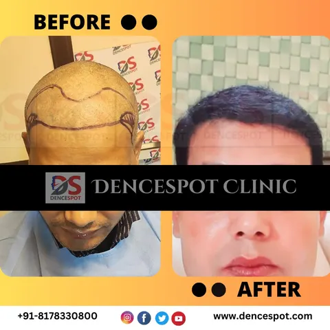 Hair transplant before and after, photo 4 — consented DenceSpot Clinic patient